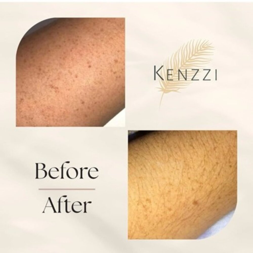 Kenzzi IPL - Picture 6 of 7